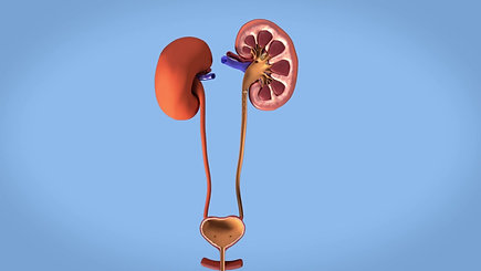 removal_of_kidney_stones