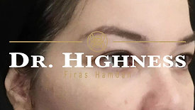 Browlift, Eyelid & Buccal Fat Removal with Dr. Highness