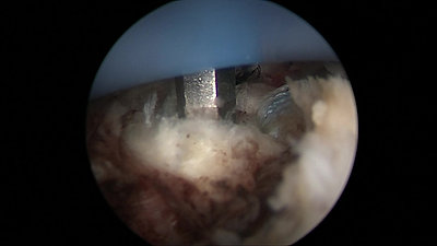 Shoulder rotator cuff suture anchor repair