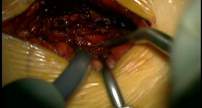 Rasp video- left sided L4-5 foraminotomy