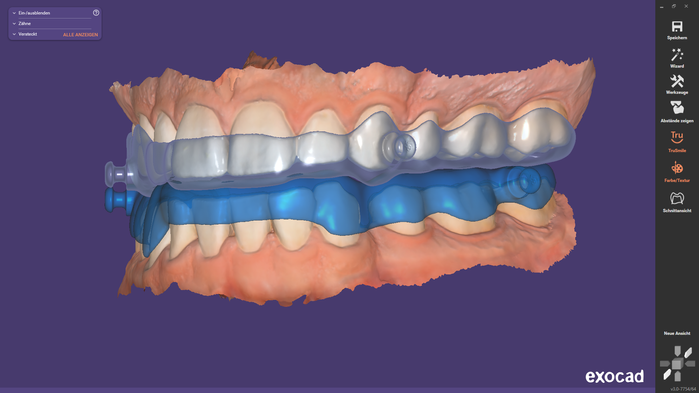 Die Konstruktion einer Schnarcherschiene im exocad DentalCAD