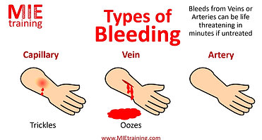 Image29 - Types of bleeding (VIDEO)