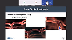 Acute Stroke Treatments