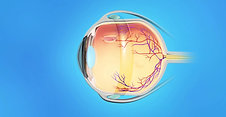 Retina Animation: Detached Retina Scleral Buckle