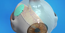Glaucoma Animation: Implant Surgery