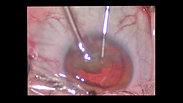 Cataract Surgery Explained