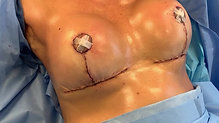 Downsize & Lift - Breast Augmentation Revision