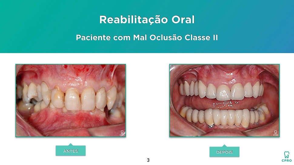 Reabilitação Oral em Paciente com Mal Oclusão Classe II 