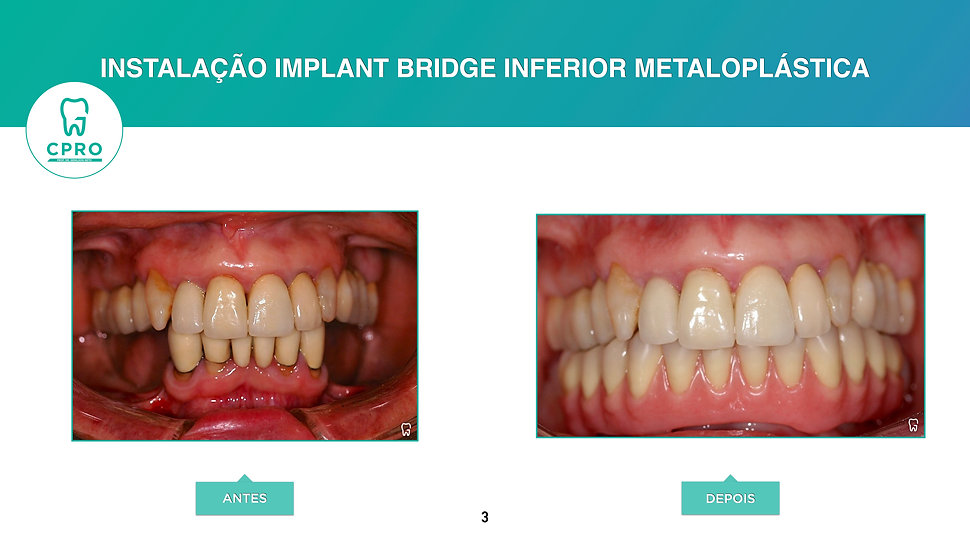 Implant Bridge Inferior Metaloplástica 