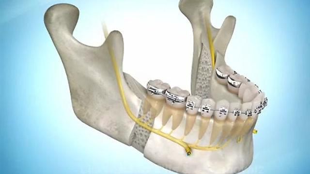 Avanco de maxila e recuo de mandibula - Ortognatica - Dr Felipe