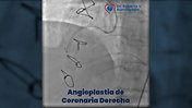 Cateterismo + Angioplastia Coronaria
