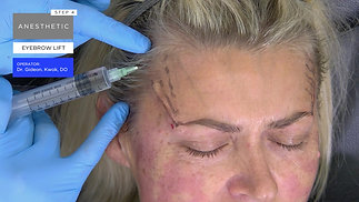 Reverse Vector Eyebrow Lift - Step 4 Anesthetic