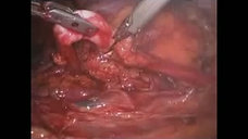 Laparoscopic Partial Nephrectomy