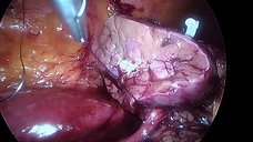 Laparoscopic Partial Nephrectomy - Technique 1