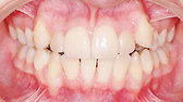 2 usynlig tannregulering