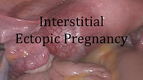 Interstitial Ectopic Pregnancy