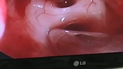 Aspecto final de ressecção tumor de hipófise pelo nariz