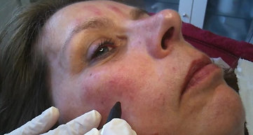 Red Vein Removal