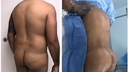 Before and after: Lipo for male