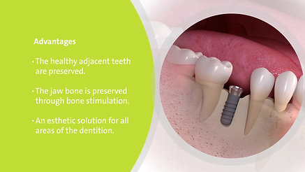 Implant replacement for single missing tooth