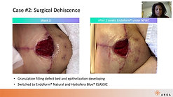 Case Study: Surgical Dehiscence