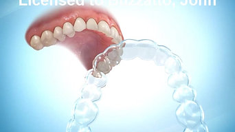 Retainer (Clear)