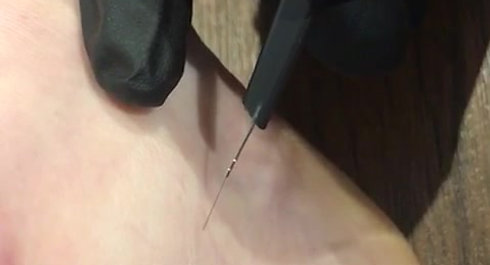 Spider Vein Removal (ankle)