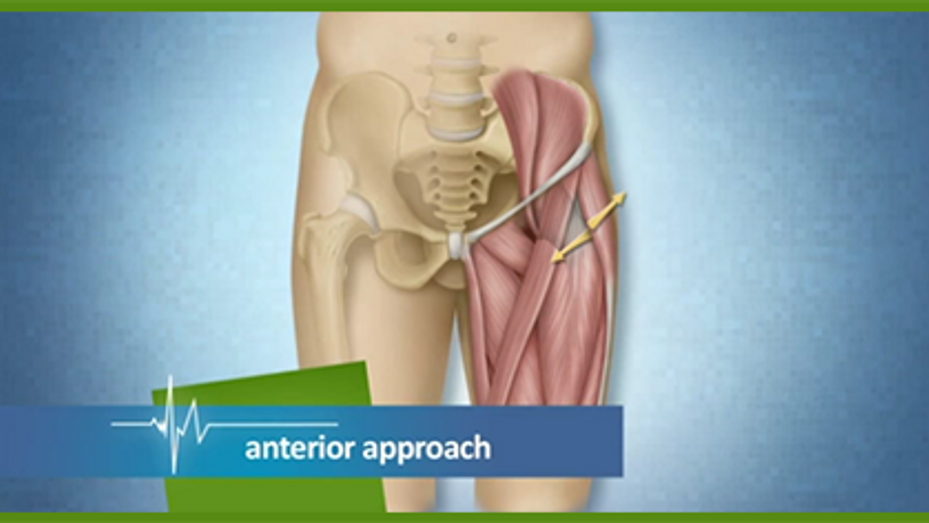 DIRECT ANTERIOR APPROACH HIP REPLACEMENT