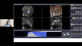 Cone Beam CT in endodonzia_ attuali certezze e prospettive future