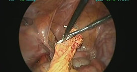 Laparoscopic Removal of a Lost IUD