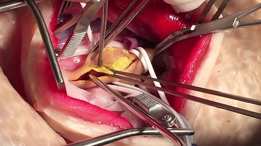 Carotid Endarterectomy