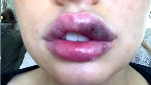 LIP FILLERS GOES WRONG! (My Experience)