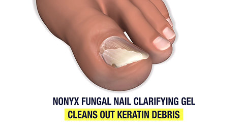 NONYX Fungal Nail Clarifying Gel clears out keratin debris where nail fungus thrives