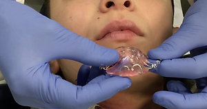Fitting of removable appliance